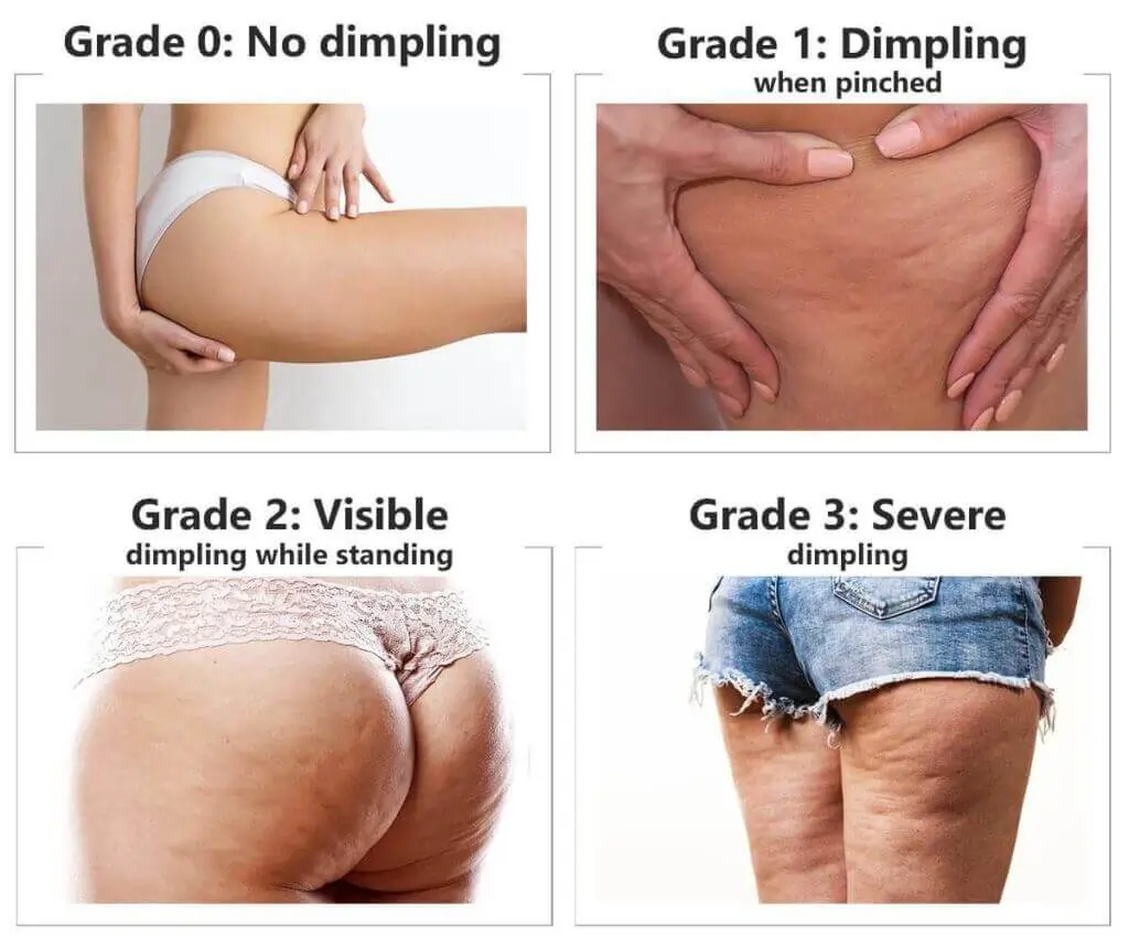 Representation of the stages of cellulite development Kent